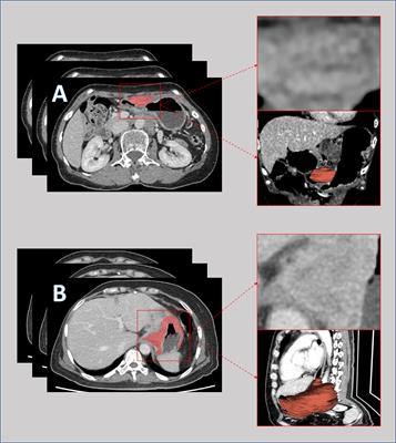 A Machine Learning Model for Predicting a Major Response to Neoadjuvant Chemotherapy in Advanced Gastric Cancer